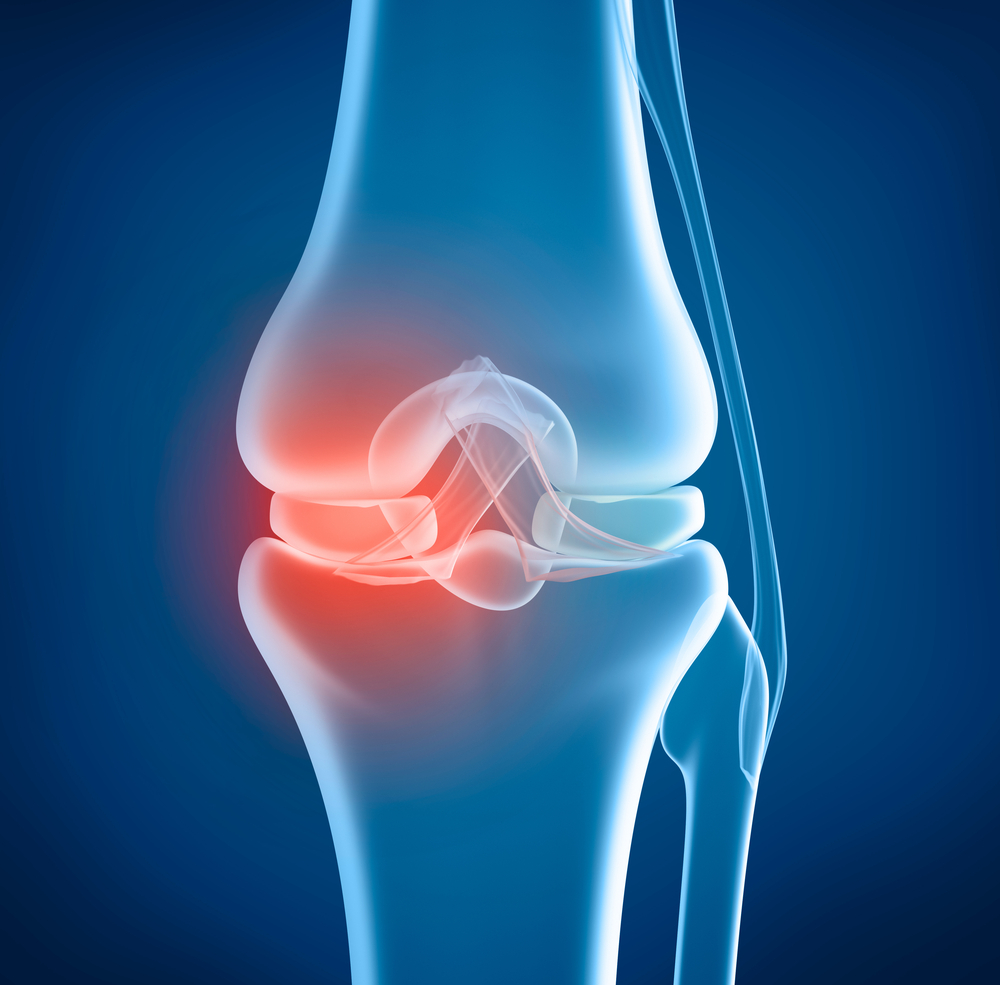 Meniscal Tear Treatment | Knee Pain Relief | Meniscal Rehab